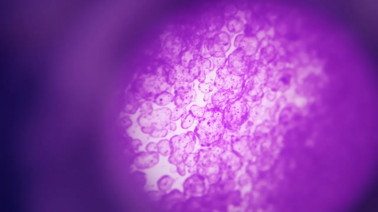 Células de cáncer de mama vistas al microscopio en un laboratorio
